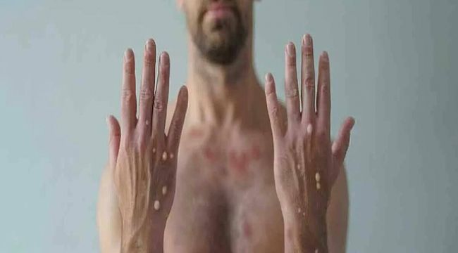 Sağlık Bakanlığı Açıkladı! Maymun Çiçeği Virüsü Türkiye'de Var mı?