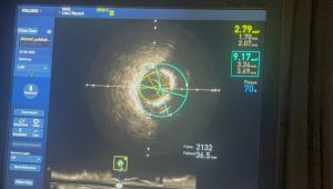Şanlıurfa’da Kardiyoloji Alanında Bir İlk: IVUS Yöntemi ile Stent Uygulaması